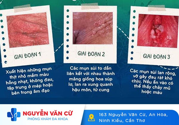 Hình Ảnh Nổi Mụn Vùng Kín – Nhận Biết Sớm Để Chữa Trị Kịp Thời