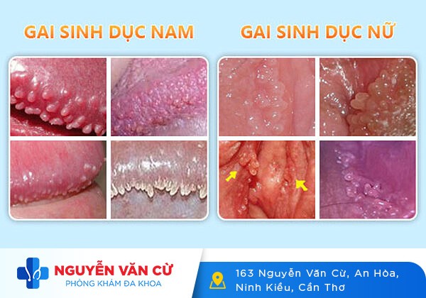 Chi tiết hình ảnh gai sinh dục ở nam và nữ giới