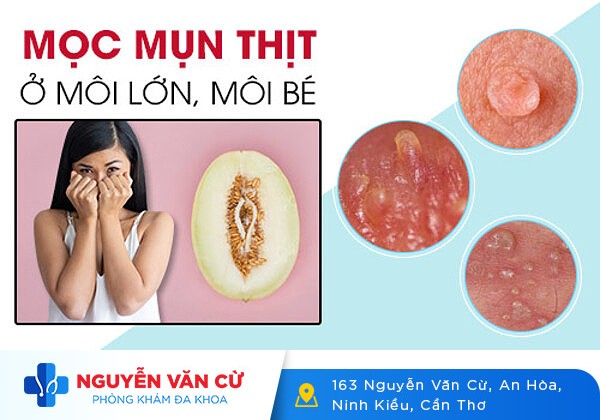 Những gì bạn không biết về thịt thừa vùng kín