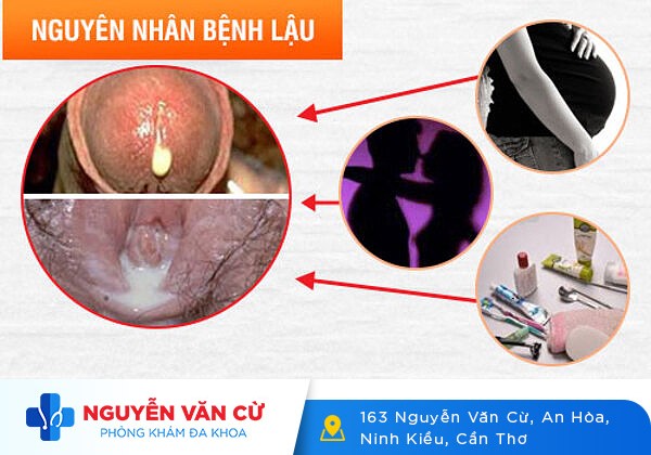 Các nguyên nhân gây ra bệnh lậu ở nam phổ biến nhất
