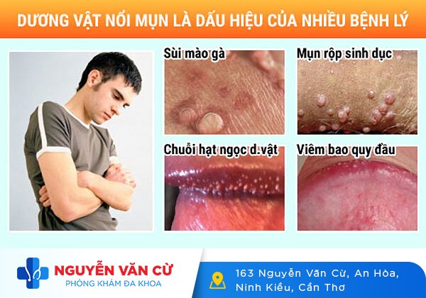 Dương Vật Nổi Mụn – Nguy Cơ Cao Bạn Mắc 1 Trong 3 Bệnh Nguy Hiểm Sau
