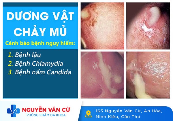 Dương vật chảy mủ trắng đục là bệnh gì?