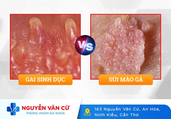 Gai âm đạo là gì? Phân biệt gai âm đạo và sùi mào gà