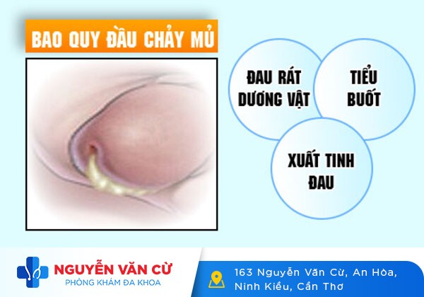 Các biểu hiện ban đầu bệnh lậu ở nam dễ nhận biết nhất