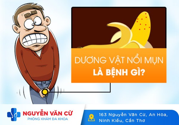 4 loại thuốc chữa trị mụn dương vật được sử dụng nhiều hiện nay