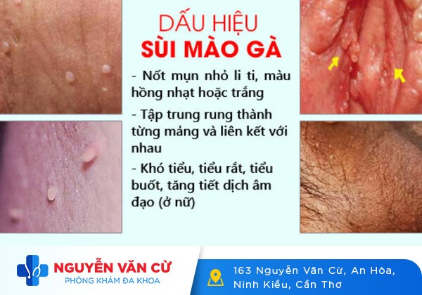 Mụn Sinh Dục Là Bệnh Gì Có Nguy Hiểm Không?