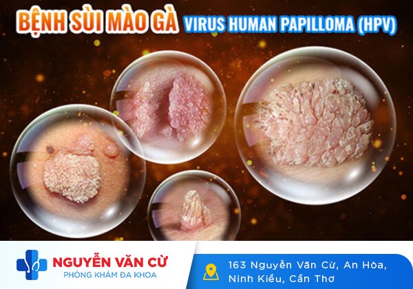 Cách Phân Biệt Mun Rộp Sinh Dục Và Sùi Mào Gà Dễ Dàng
