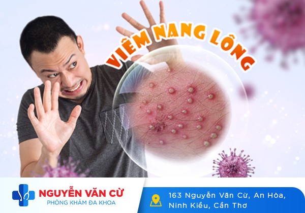 Cách chữa mụn vùng kín và địa chỉ chữa trị uy tín bạn nên biết