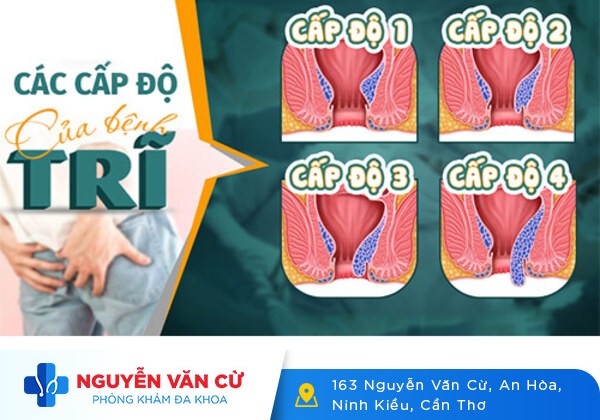 Các phương pháp cắt trĩ, mổ trĩ năm 2026