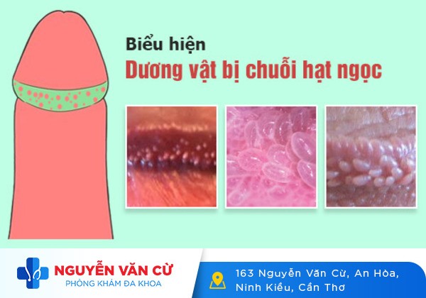 Dương vật nổi mụn nước là bị gì?