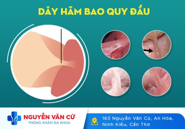 Dây Hãm Bao Quy Đầu Bị Đau Và Cách Xử Lý