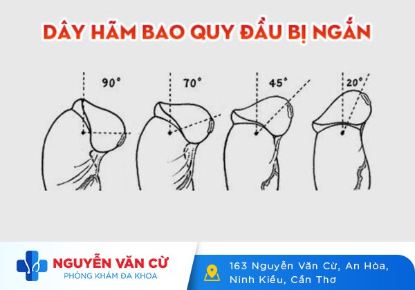 Chi Phí Cắt Dây Hãm Bao Quy Đầu Rẻ