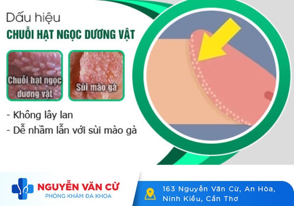 Hạt ngọc dương vật có phải sùi mào gà không?