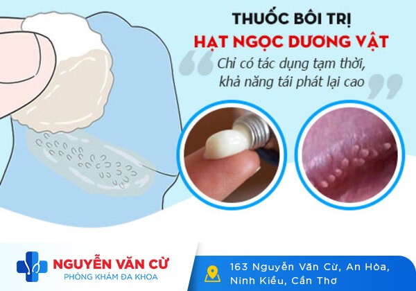 Thuốc chữa trị hạt ngọc dương vật loại nào tốt?