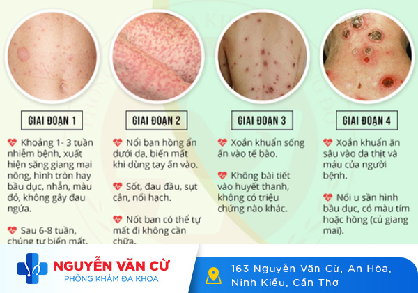 Dấu hiệu bệnh giang mai qua các giai đoạn được biểu hiện như thế nào?