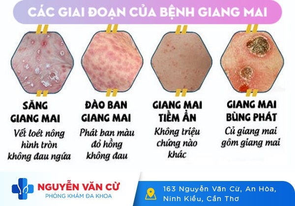 Thuốc điều trị bệnh giang mai có những loại nào? Hiệu quả ra sao?