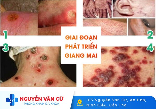 Bệnh giang mai nguy hiểm như thế nào?
