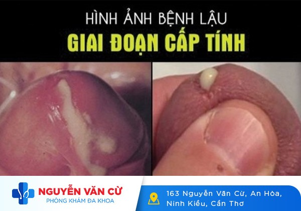 Hình ảnh bệnh lậu ở nam giới như thế nào?