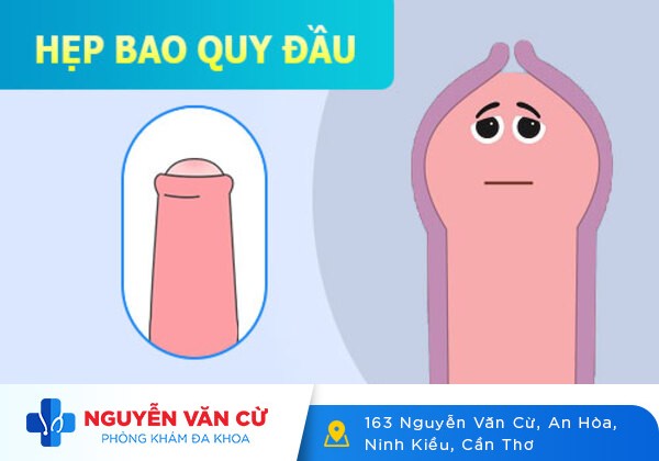 Thế Nào Là Hẹp Bao Quy Đầu?