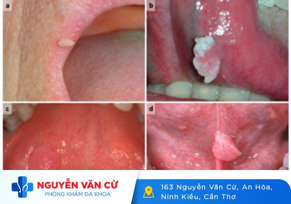Sùi mào gà ở lưỡi, cẩn thận nhầm lẫn với nhiệt miệng, viêm amidan