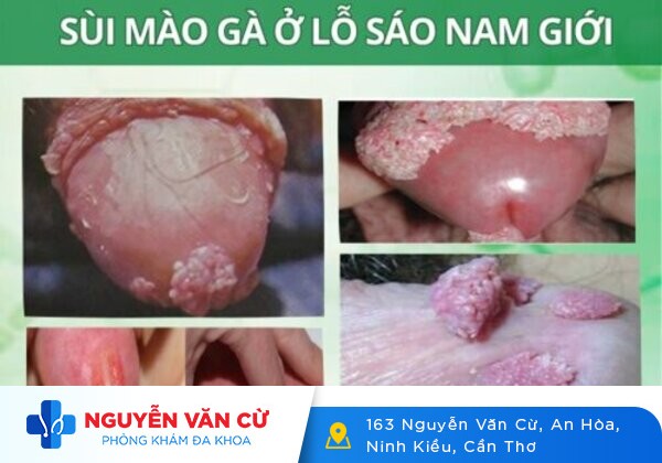 Bao Quy Đầu Nổi Mụn Trắng Là Bệnh Gì?
