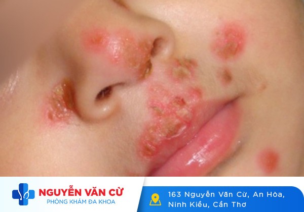 Môi Nổi Hột Bất Thường – Cảnh Báo Mắc Bệnh Hoa Liễu Nguy Hiểm