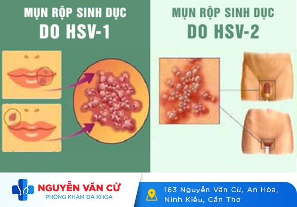 Tổng quan về mụn rộp sinh dục