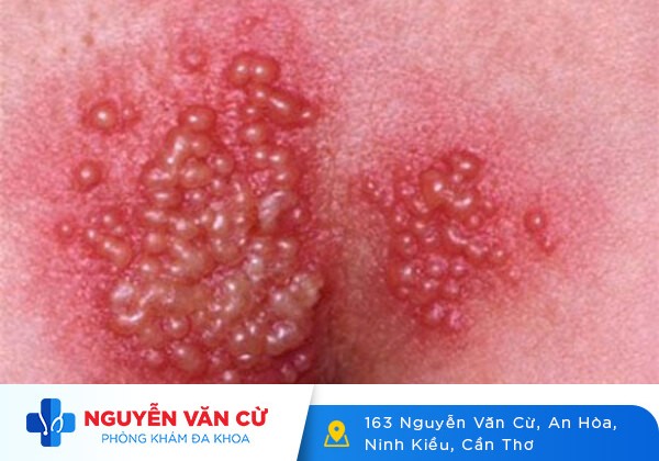 Nổi Mụn Ở Mu – Nguyên Nhân Và Cách Điều Trị Hiệu Quả
