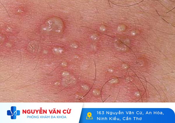 Mụn Nước Ở Thân Dương Vật – Triệu Chứng Bệnh Hoa Liễu Nguy Hiểm Cần Biết