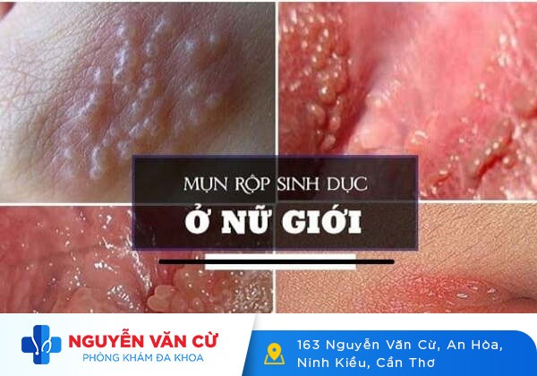 Nổi Mụn Âm Đạo Là Triệu Chứng Bệnh Gì?