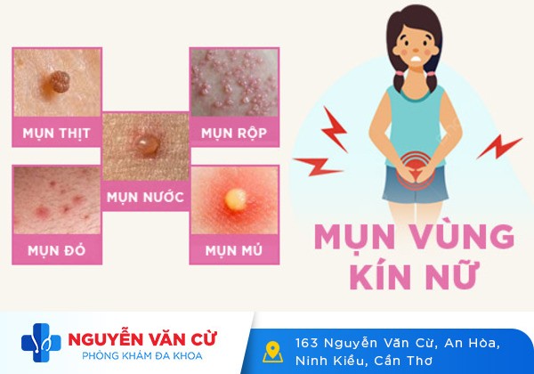 Cẩn thận với hiện tượng nổi mụn ở môi lớn, môi bé âm đạo
