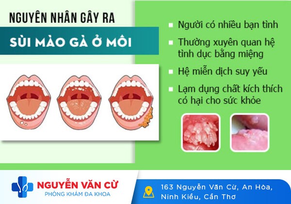 Bạn đã biết gì về bệnh sùi mào gà ở lưỡi