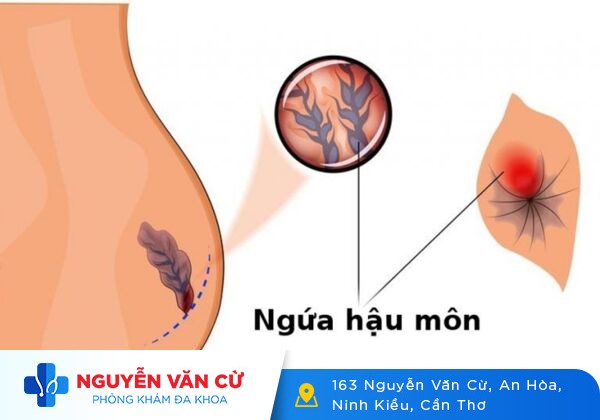 Giải Pháp Hỗ Trợ Điều Trị Ngứa Hậu Môn Hiệu Quả An Toàn Cao