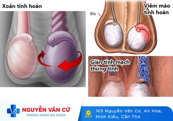 Giải Mã Hiện Tượng Sưng Tinh Hoàn Ở Nam Giới