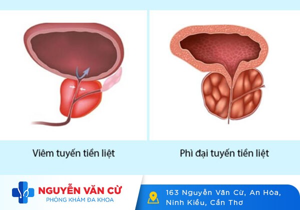 Đau Tuyến Tiền Liệt Có Nguy Hiểm Không?