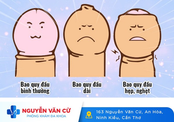 Cắt Da Bao Quy Đầu Và Những Thông Tin Cần Biết