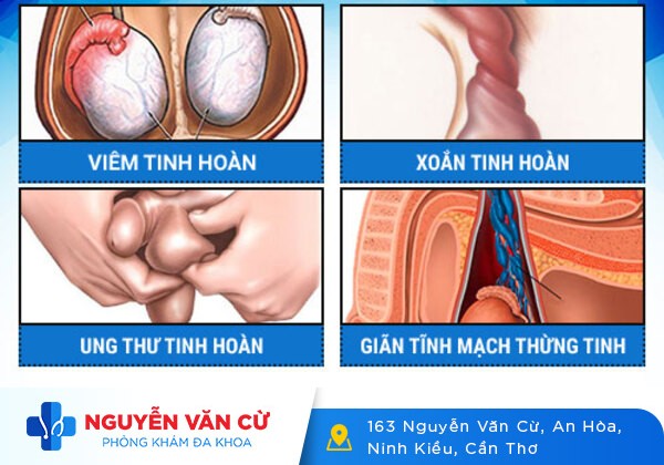 Sưng Tinh Hoàn 1 Bên Dấu Hiệu Mắc bệnh ngoại khoa nam Nguy Hiểm