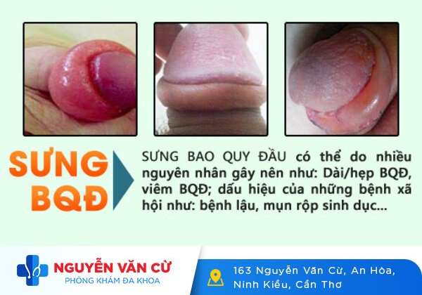 Sưng đầu dương vật và cách điều trị hiệu quả