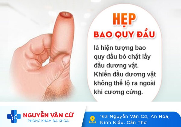 Hẹp Bao Quy Đầu Ở Người Lớn