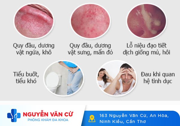 Các Cách Điều Trị Nấm Dương Vật Được Bác Sĩ Khuyên Dùng