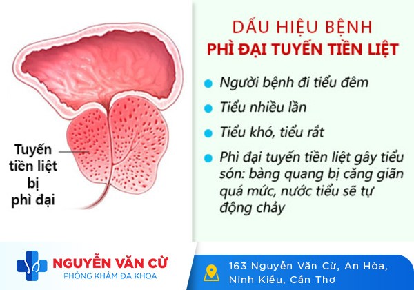 Đi tiểu lâu ra là bệnh gì chữa trị ra sao?