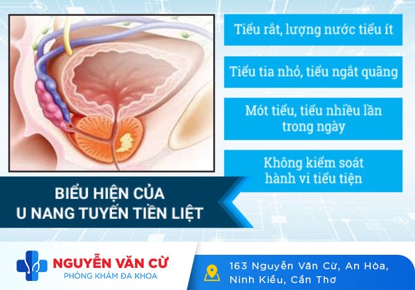 Những Thông Tin Cần Biết Về U Nang Tuyến Tiền Liệt