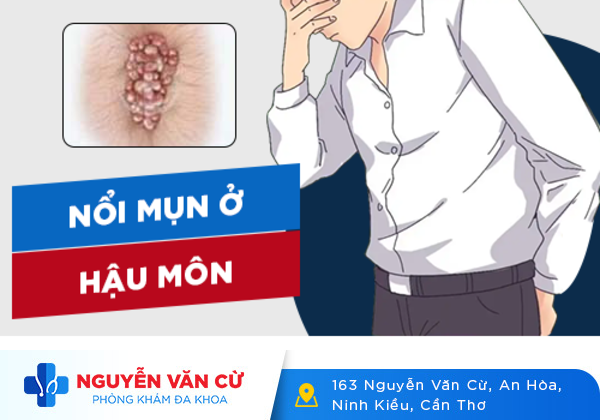 Nổi mụn hậu môn dấu hiệu không nên xem thường