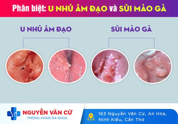 Tiền Đình U Nhú Và Cách Phân Biệt Với Sùi Mào Gà