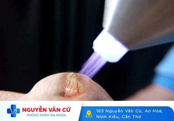 Bắn Laser Trị Sùi Mào Gà Có Hiệu Quả Không