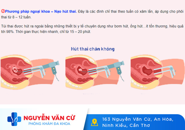 Phương pháp nạo thai an toàn