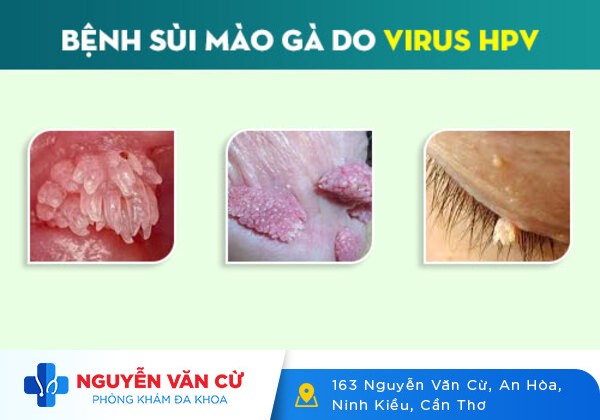 Chi tiết hình ảnh bệnh sùi mào gà tại các vị trí trên cơ thể