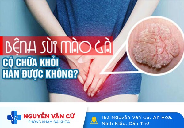 Sùi mào gà tái phát – 10 phút để hiểu rõ