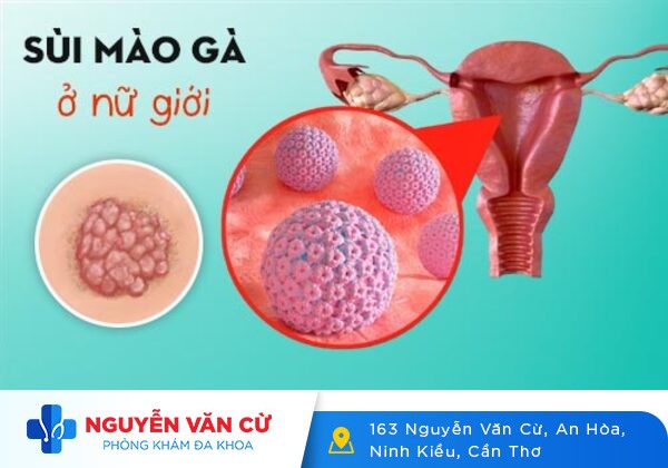 Nỗi lo khi xuất hiện thịt dư âm đạo