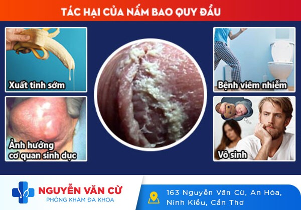 Bợn trắng bao quy đầu là bị sao? Có nguy hiểm không?